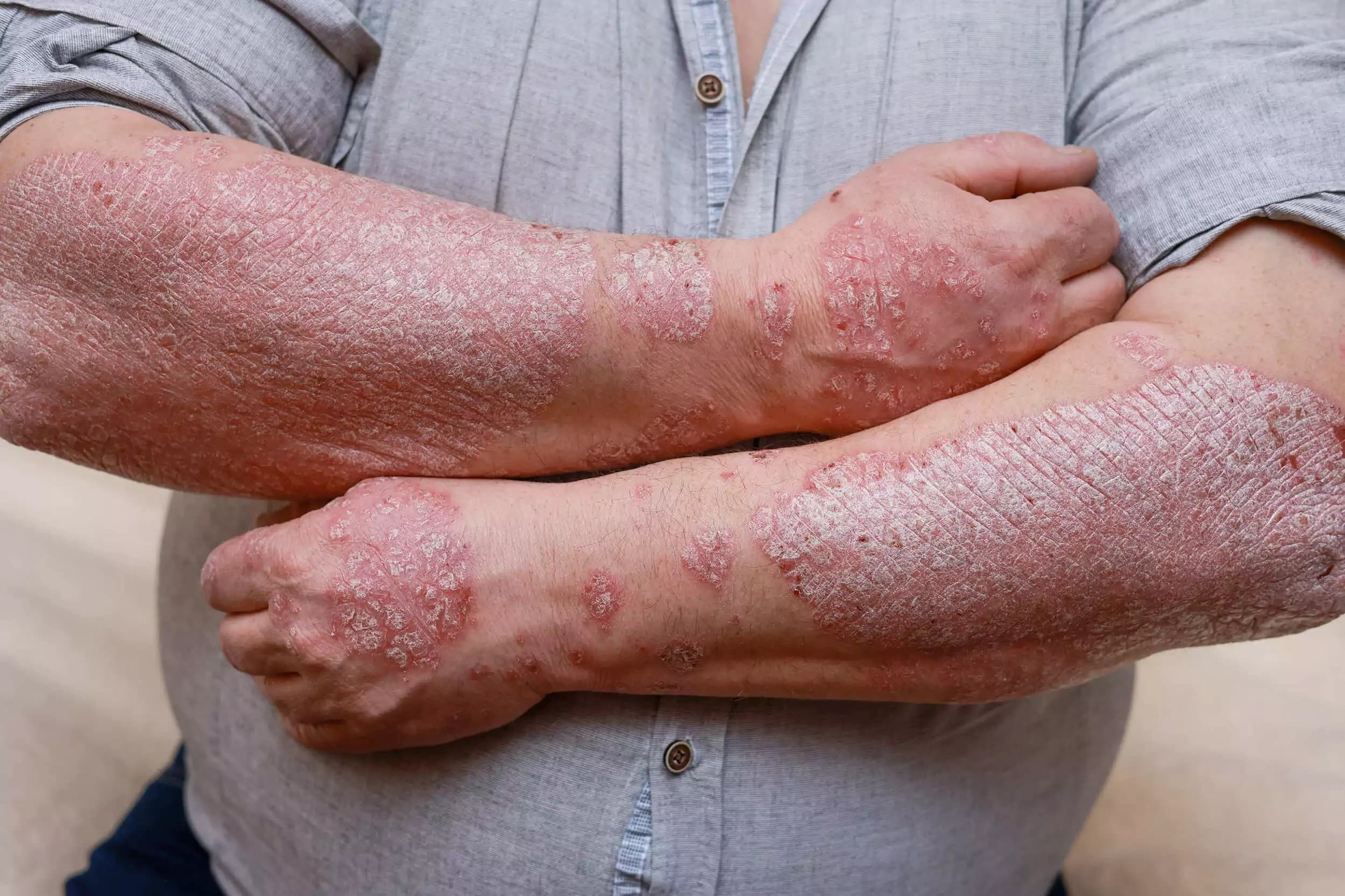 Bőrgát (skin barrier) egyszerűen – miért romlik, és hogyan támogatható érzékeny bőrön