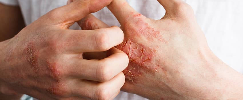 Pikkelysömör és társbetegségek – mire kell még odafigyelni?